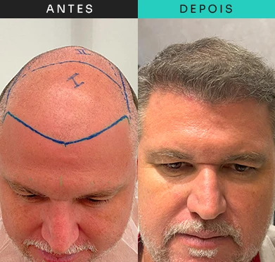 transplante-capilar-tratamento-2.webp