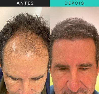 transplante-capilar-tratamento-4.webp