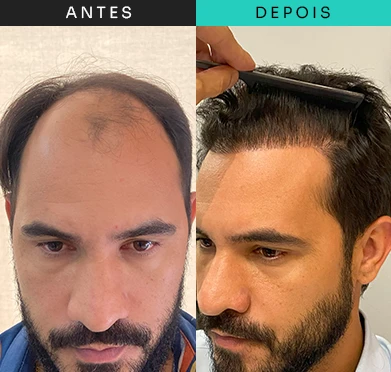 transplante-capilar-tratamento-7.webp
