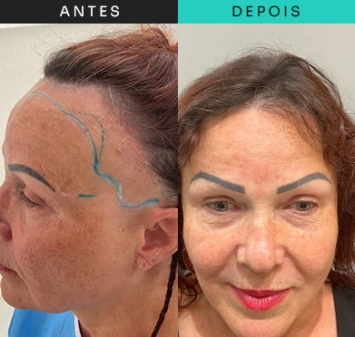 transplante-capilar-tratamento-8.webp